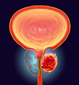 Getty illustration of 3d prostate cancer illustration