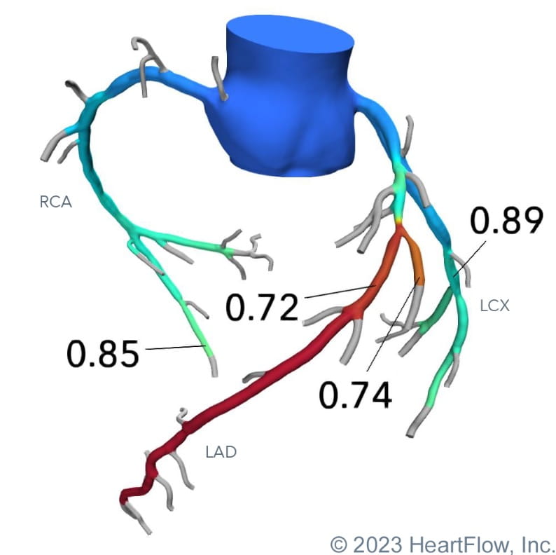 Heart Flow Analysis Example