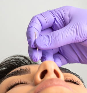 Thumbnail image of woman receiving acupuncture at bridge of nose