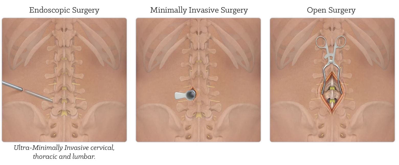 Spinal surgery types