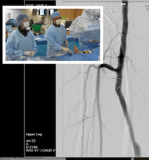 UH Research Shows Minimally Invasive Procedure Saves Most Patients from Amputation