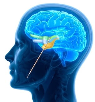Thumbnail image of an illustration showing a brain ablation.