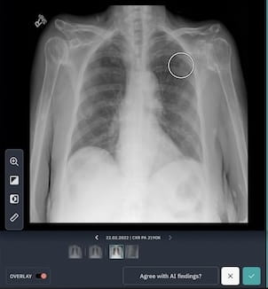 Thumbnail image of AI chest x-ray