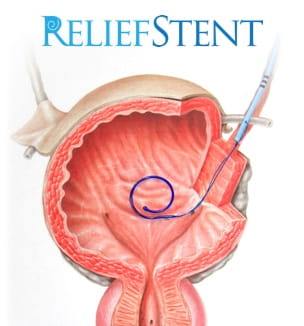 ReliefStent in bladder